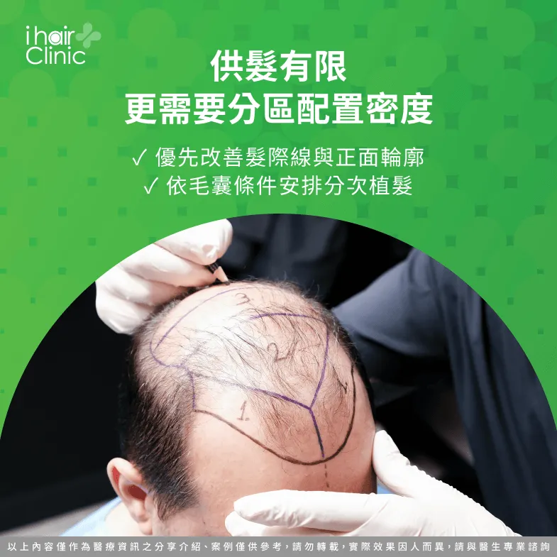 供髮毛囊有限怎麼規劃?分區配置密度與分次植髮 毛囊有限-大面積禿頭可以植髮嗎