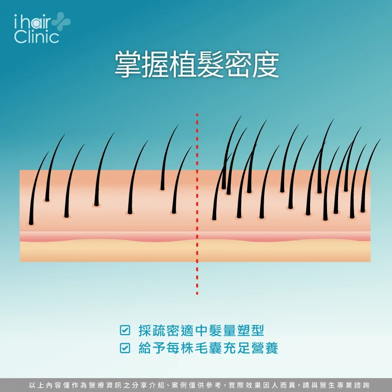 把握植髮密度-植髮會傷害原生髮嗎