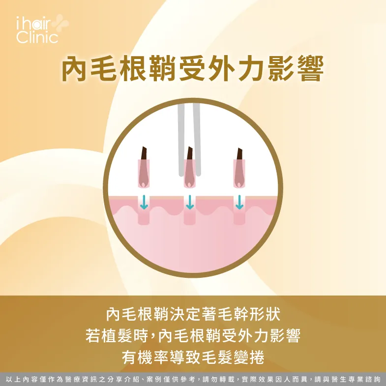 內毛根鞘受外力影響無法規則生長-植髮 後 捲髮