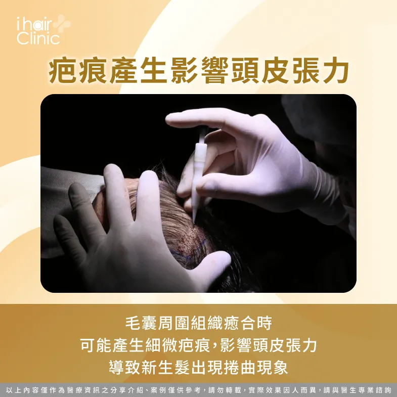 疤痕增生可能影響頭皮張力造成毛髮捲曲-植髮 後 捲