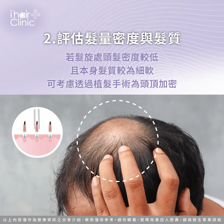 根據髮量密度與髮質規劃合適取髮範圍-植髮 髮旋
