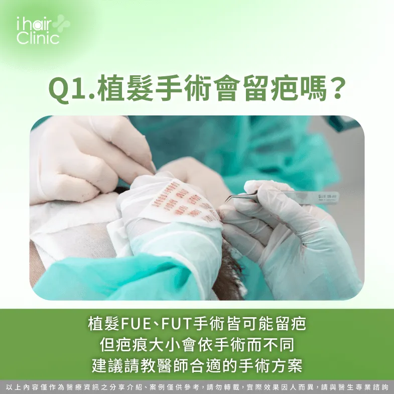 不論接受FUE或FUT植髮手術,術後均會留下疤痕,因此建議主動諮詢醫師,請教合適的植髮手術與方案 植髮FUE或FUT均可能留下疤痕-植髮 會 有 傷口 嗎