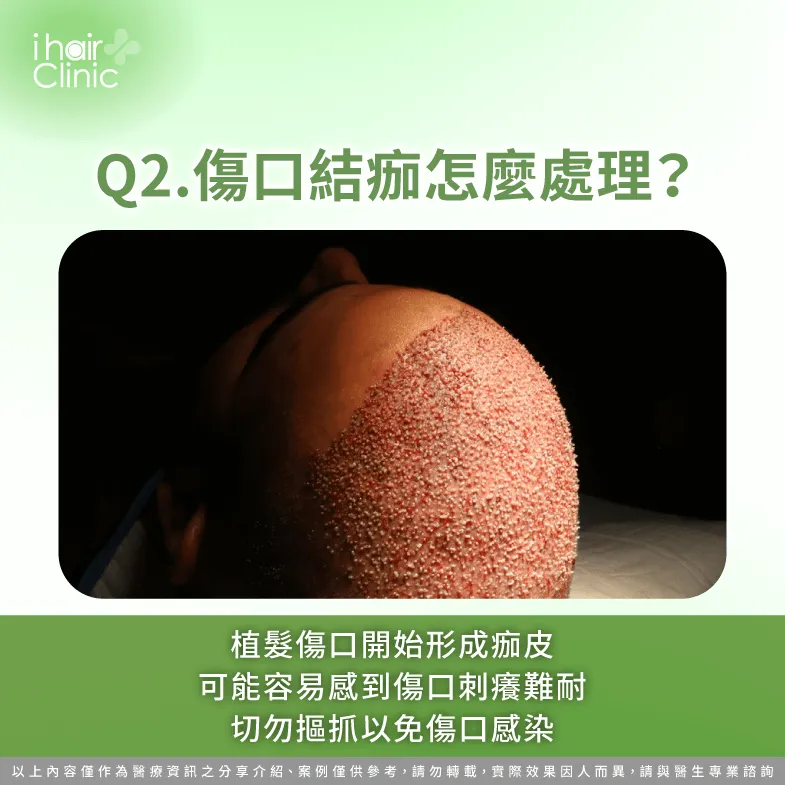 當傷口結痂時,切勿使用手指摳抓,應等待其自然脫落即可 傷口結痂建議等待其自然脫落即可-植髮 後 傷口