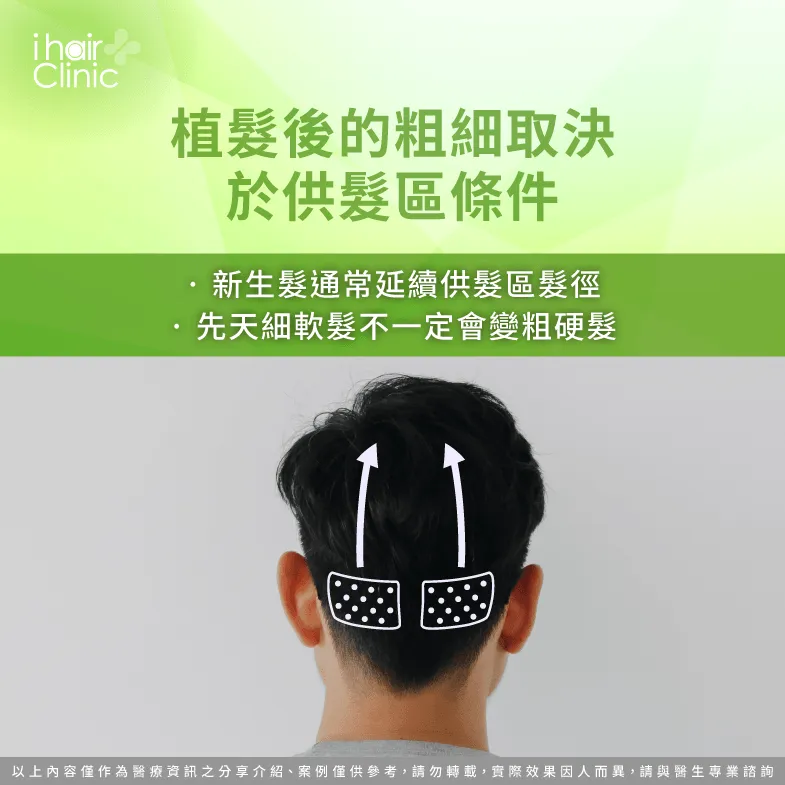 植髮後髮絲粗細由什麼決定?供髮區髮徑與髮質是關鍵 供髮區條件-植髮後會和原本頭髮一樣粗嗎