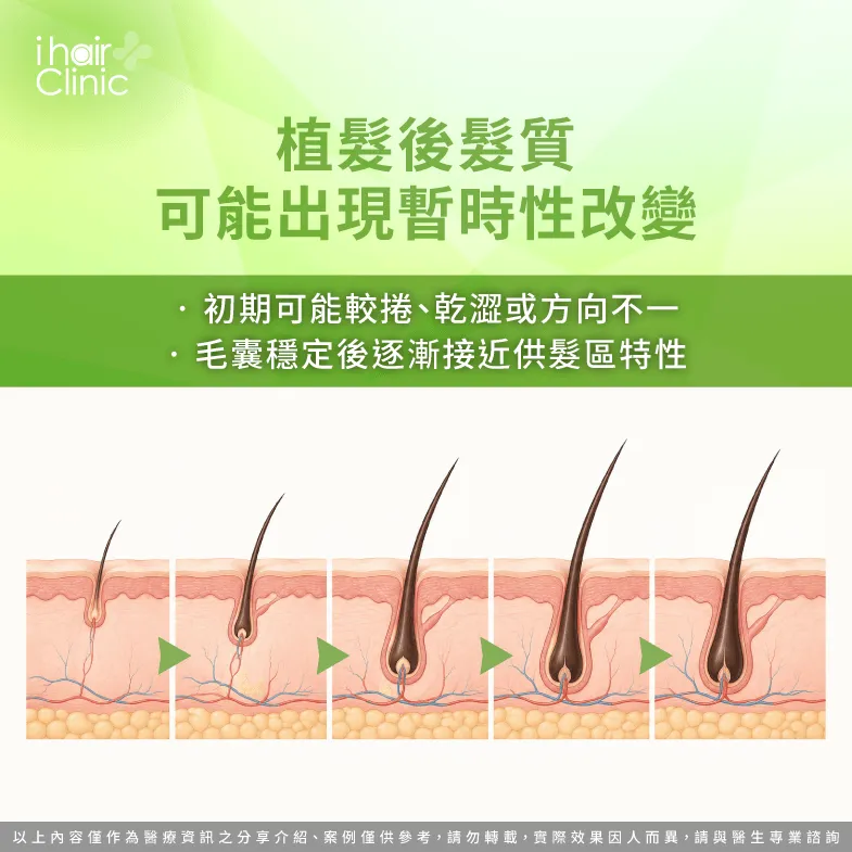 植髮後髮質會改變嗎?了解捲曲、乾澀與毛囊穩定期 暫時性髮質變化-植髮 頭髮 粗細
