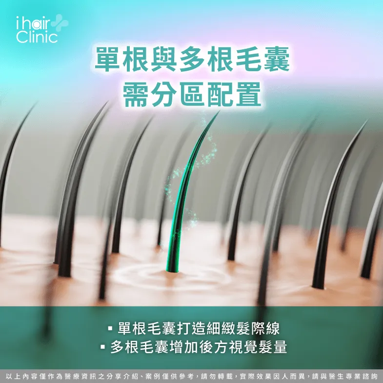單根與多根毛囊分區配置:打造自然髮線與視覺髮量 毛囊配置-植髮效果自然嗎