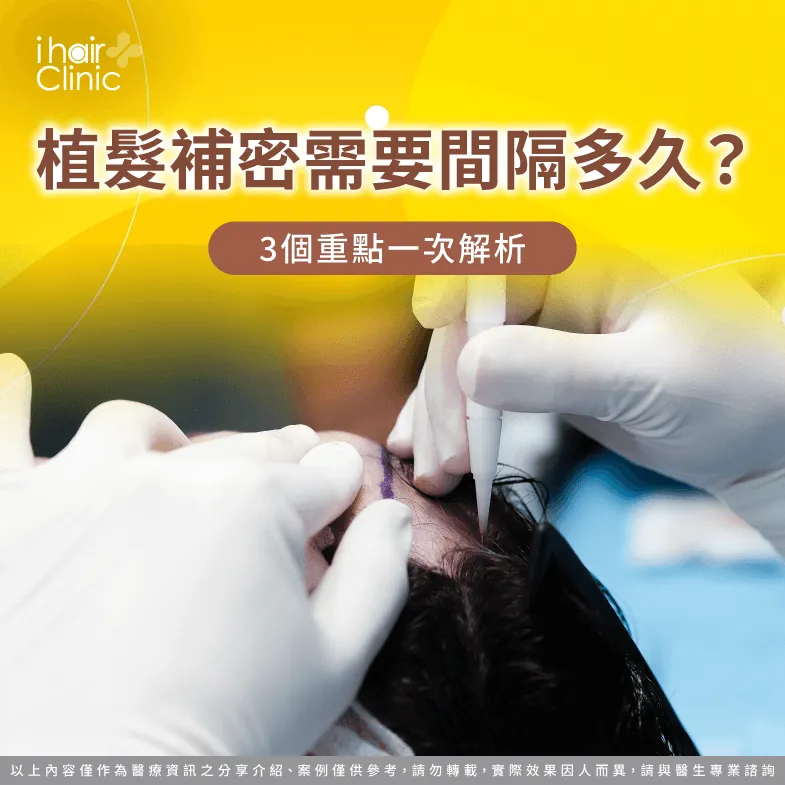植髮補密需要間隔多久-植髮 補密 多久