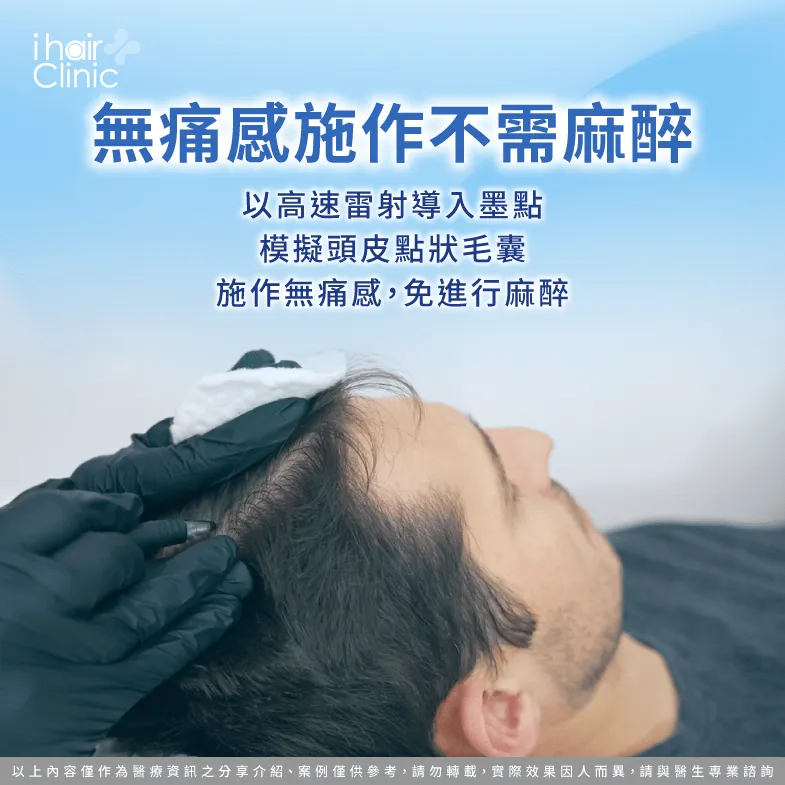 以高速雷射量能導入墨點施作無痛感-紋髮 失敗