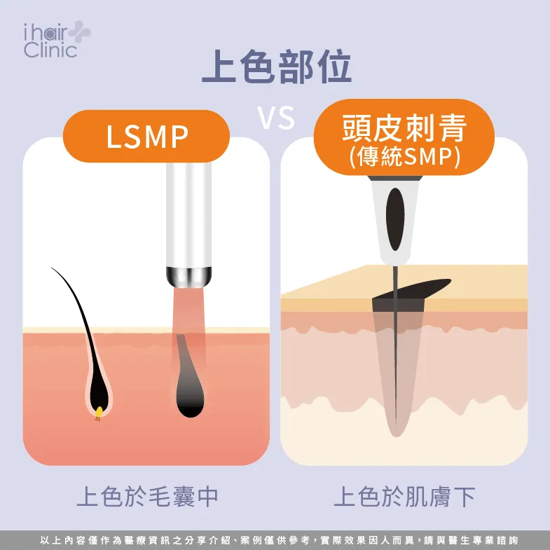 上色部位不同-LSMP是刺青嗎