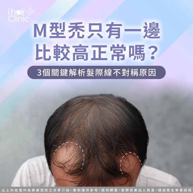 M型禿只有一邊比較高正常嗎?3個原因一次解析 M型禿只有一邊比較高-M型禿不對稱