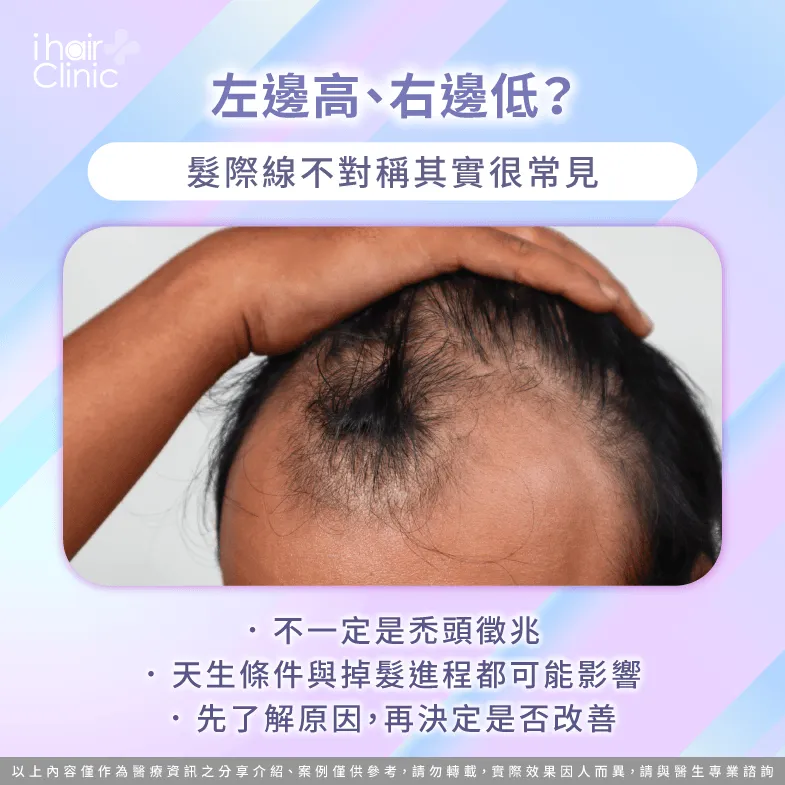 髮際線左右不對稱正常嗎?常見原因一次了解 髮際線不對稱-M型禿只有一邊比較高