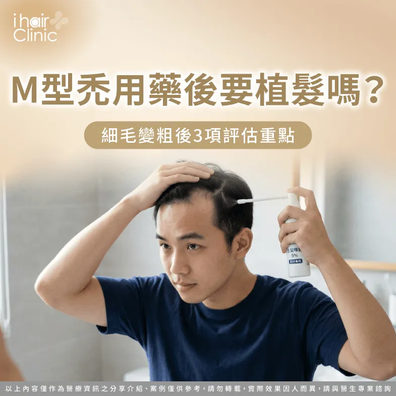 M型禿用藥後細毛變粗,還需要植髮嗎?3項評估重點 M型禿用藥後要植髮嗎-M型禿治療後植髮