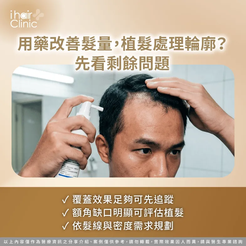 用藥後還要植髮嗎?從髮量、額角缺口與髮線需求判斷 用藥與植髮評估-M型禿用藥後要植髮嗎