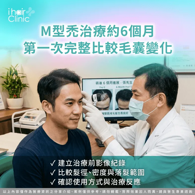 治療6個月追蹤-M型禿多久檢查一次
