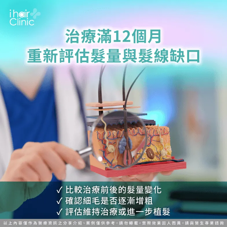 治療12個月評估-M型禿多久檢查一次