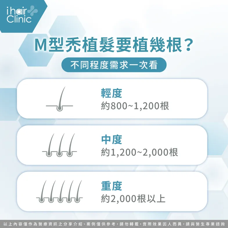 不同程度M型禿,需要的植髮根數一次了解 不同植髮型態根數-M型禿植髮幾根