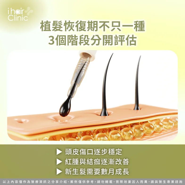 植髮恢復期怎麼看?頭皮傷口、術後外觀與新生髮3階段 恢復進度-M型禿植髮多久恢復