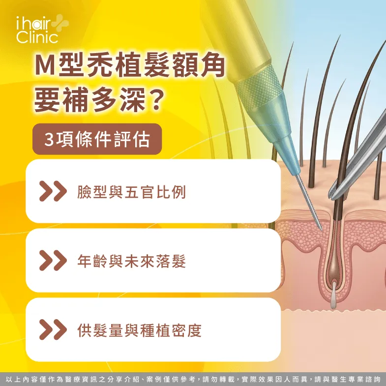 M型禿植髮 補額角-M型禿額角植髮
