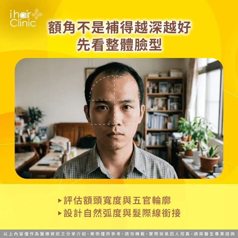 臉型與額角設計-M型禿植髮額角要補多深