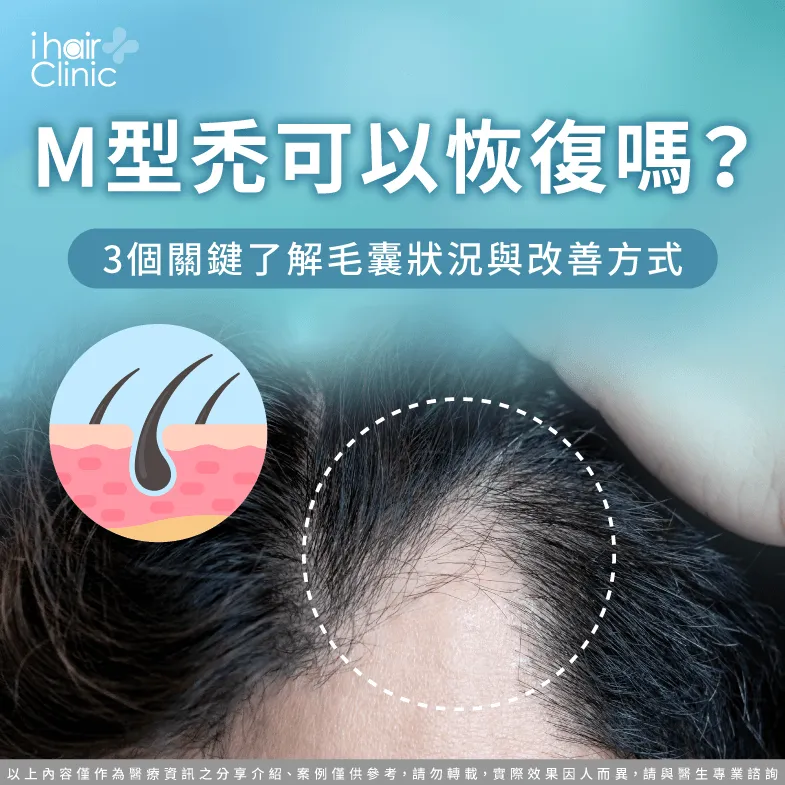 M型禿可以恢復嗎?3個關鍵了解毛囊與改善方式 M型禿可以恢復嗎-M型禿恢復