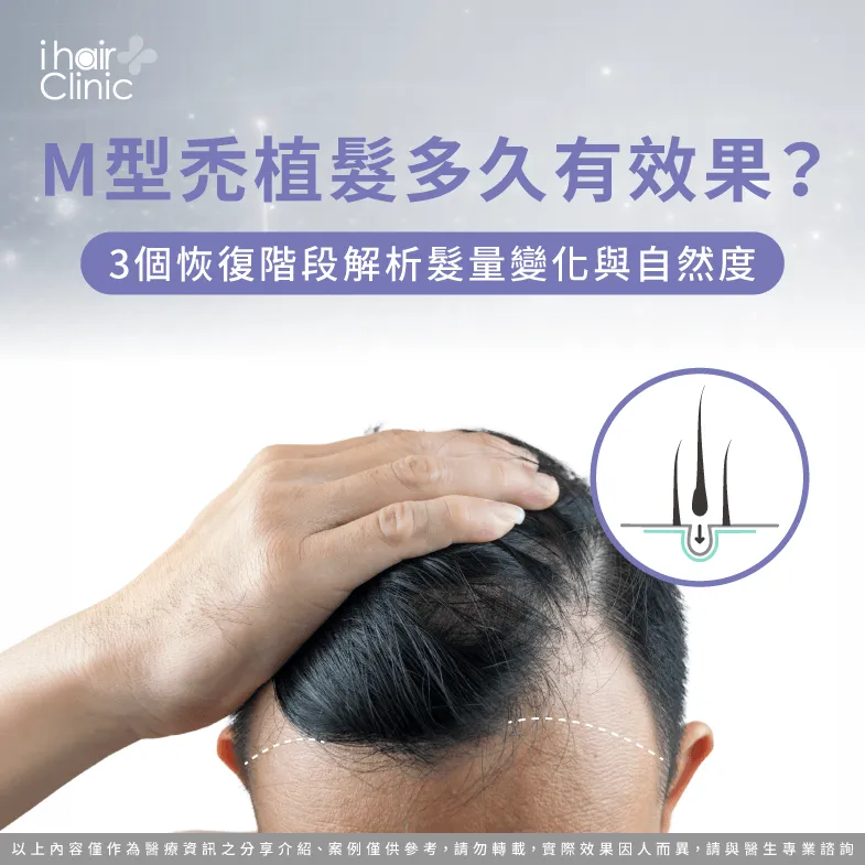 M型禿植髮多久有效果-M型禿植髮多久自然