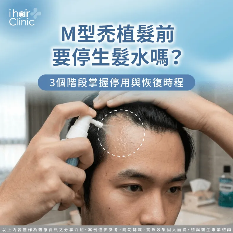 M型禿植髮前要停生髮水嗎?3階段掌握停用與恢復時程 M型禿植髮前要停生髮水嗎-植髮前生髮水停多久
