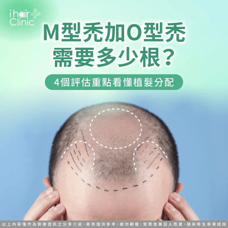 M型禿加O型禿需要多少根?植髮數量與區域分配4大重點 M型禿加O型禿需要多少根-M型禿 O型禿 植髮