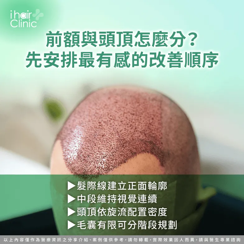 M型加O型禿怎麼分配毛囊?前額、中段與頭頂完整規劃 植髮區域分配-M型禿 O型禿 植髮