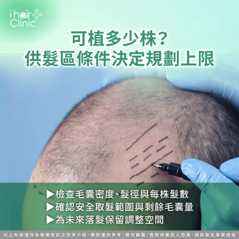 供髮區可植多少株?毛囊密度、安全取髮與預留量評估 供髮區條件評估-M型禿加O型禿需要多少根