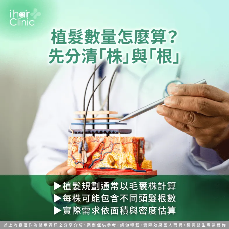 植髮根數怎麼計算?毛囊株、頭髮根數與種植密度解析 毛囊株與頭髮根數-M型禿 O型禿 植髮