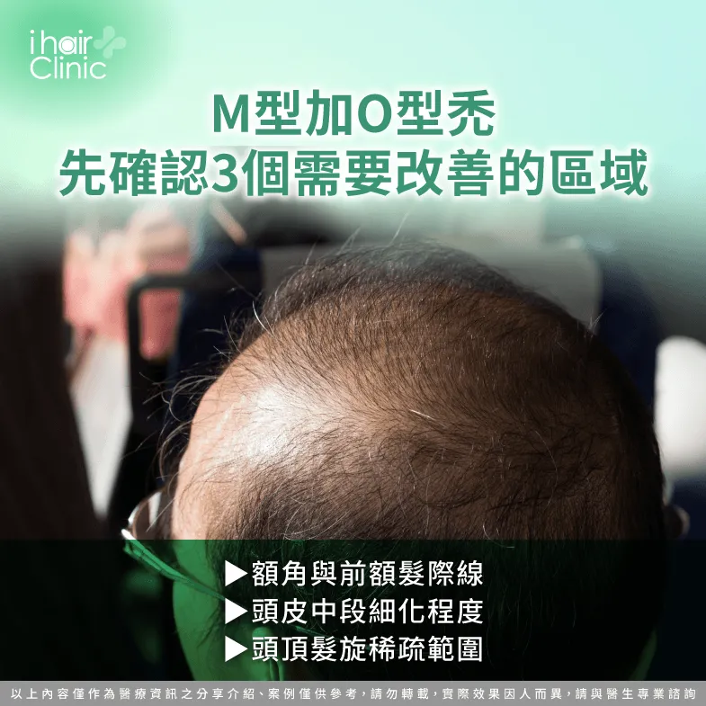 M型加O型禿要補哪些區域?前額、中段與頭頂3區評估 三區植髮範圍評估-M型禿加O型禿需要多少根