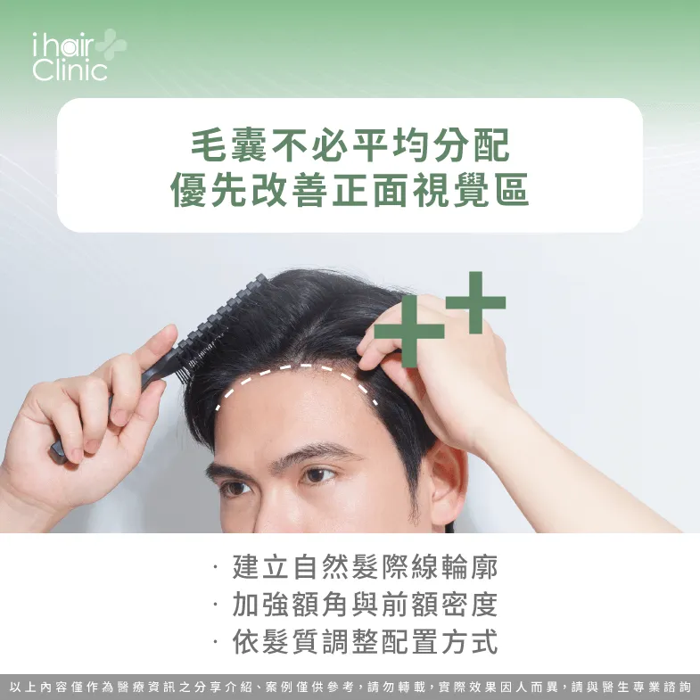 M型禿毛囊怎麼分配?優先改善髮際線、額角與前額密度 正面毛囊配置順序-M型禿供髮量不足
