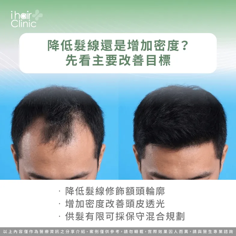 降低髮線還是增加密度?M型禿植髮3種規劃方式比較 髮線與密度取捨-M型禿供髮量有限