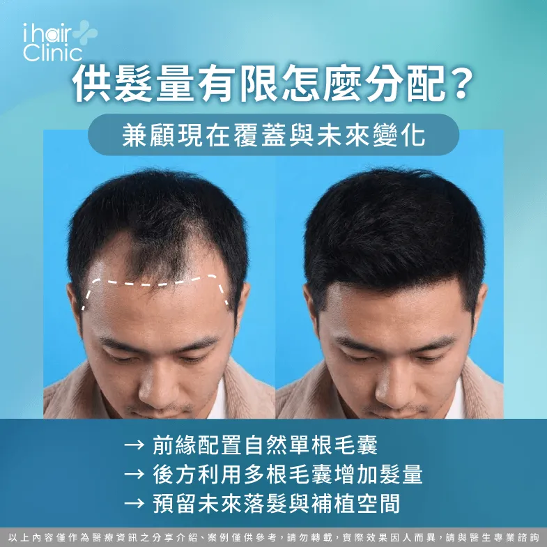 細軟髮供髮量怎麼分配?兼顧自然覆蓋與未來補植 供髮量與毛囊配置-細軟髮M型禿植髮