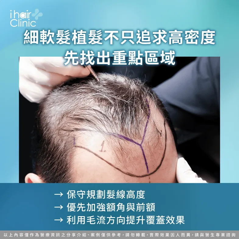 細軟髮植髮怎麼提升覆蓋力?先規劃髮線與重點密度 髮線與重點密度-細軟髮M型禿植髮