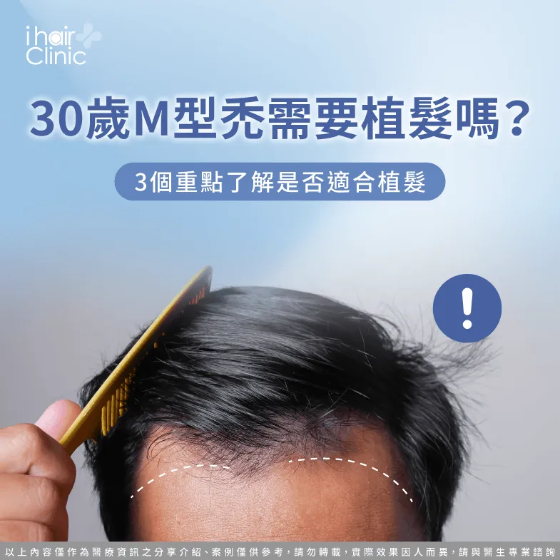 30歲M型禿需要植髮嗎?3個重點了解是否適合植髮 30歲M型禿 植髮-30歲植髮