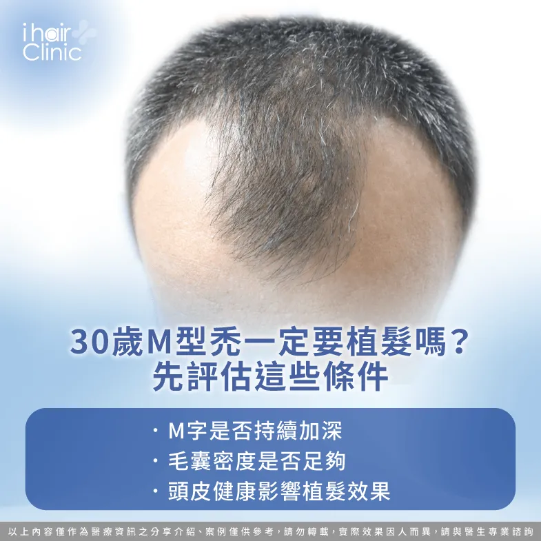 30歲M型禿需要植髮嗎?先了解評估重點 植髮評估條件-30歲M型禿