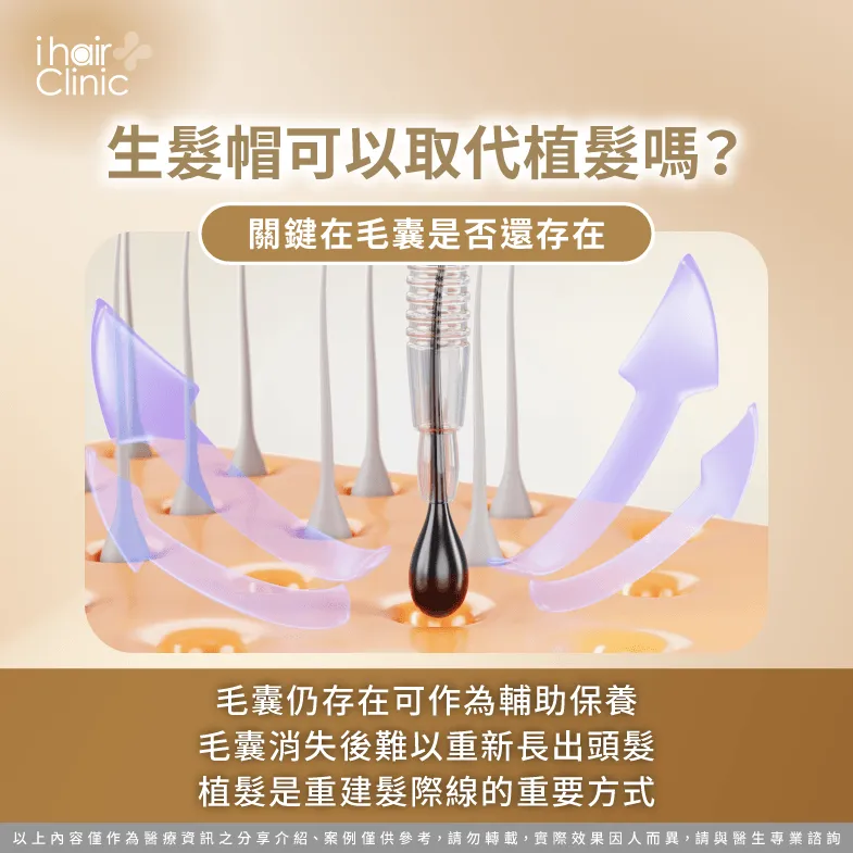 生髮帽能取代植髮嗎?關鍵在毛囊狀態 植髮取代-M型禿植髮 生髮帽 比較