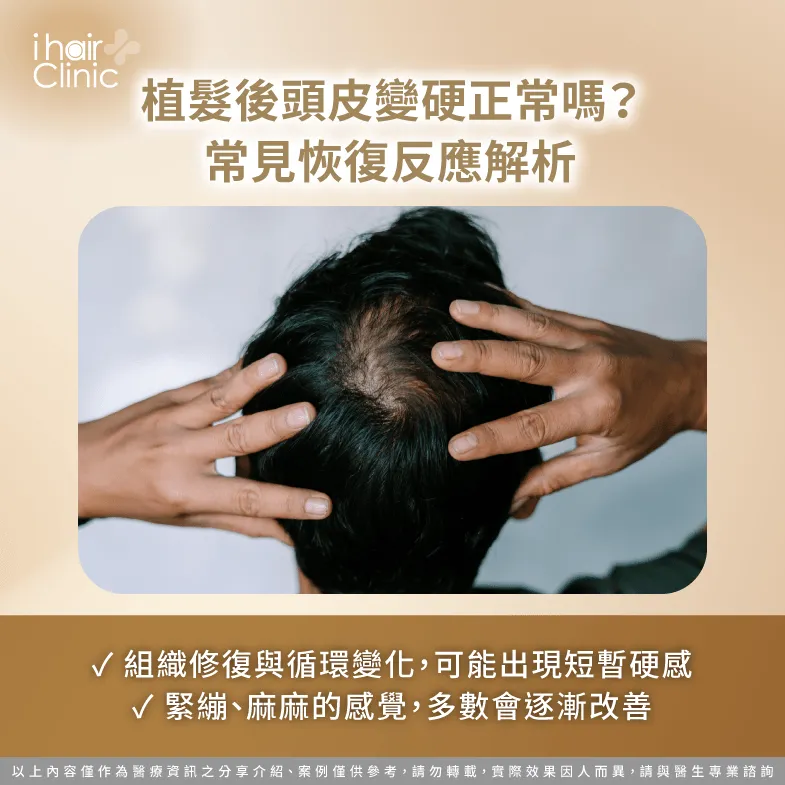 植髮後頭皮摸起來硬硬的?常見恢復反應解析 恢復期正常反應-植髮 頭皮 硬