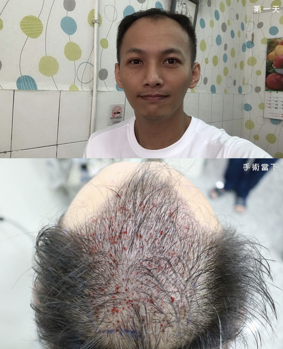 禿髮症狀-禿髮治療-台中植髮