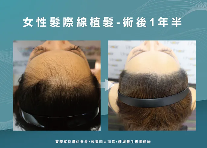 女性髮際線植髮見證-台中植髮際線