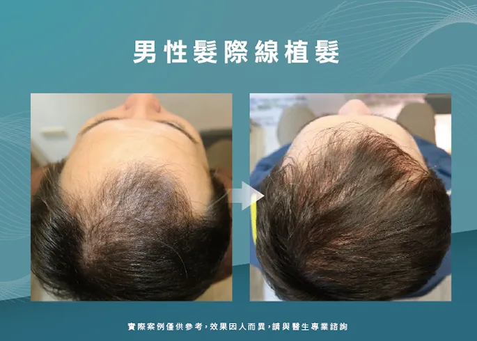 男性髮際線植髮-台中植髮際線