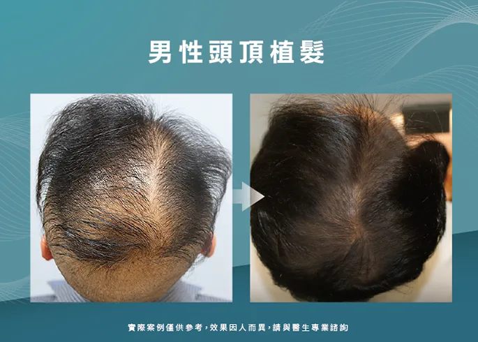男性頭頂部植髮-台中植髮診所推薦