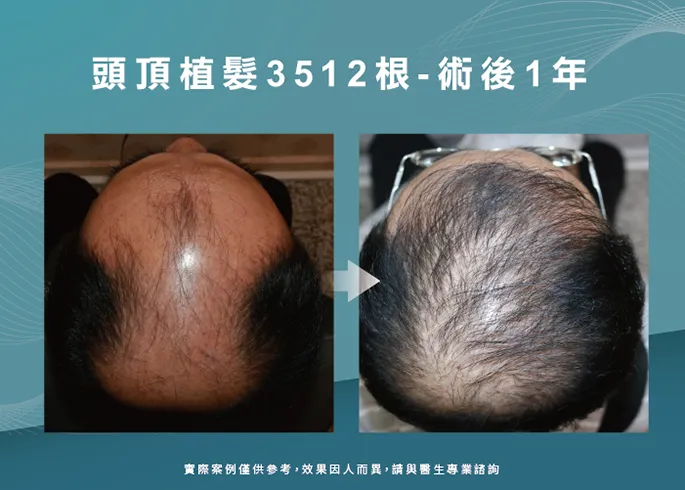 男性頭頂部植髮-台中植髮診所推薦