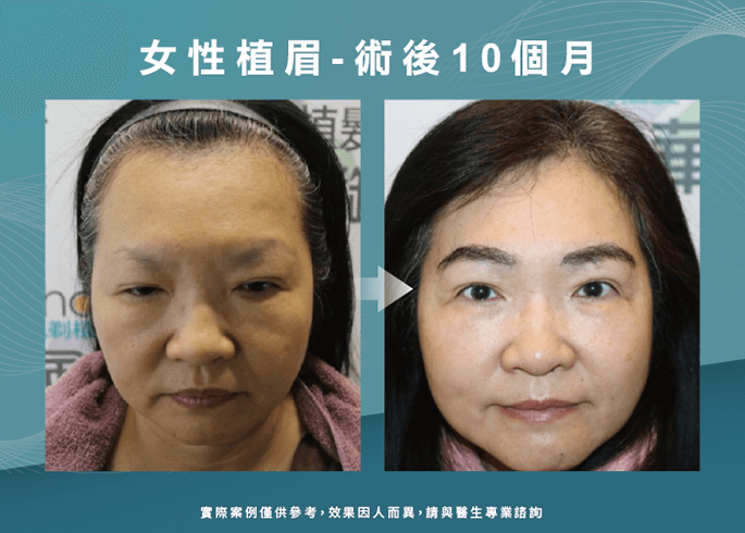 女性植眉術後10個月-台中植眉推薦