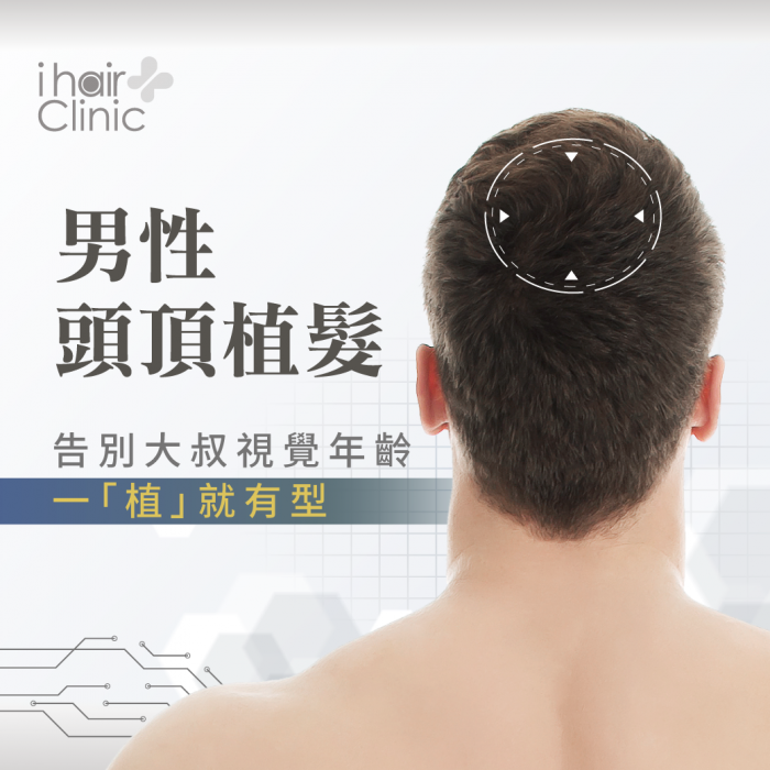男性頭頂植髮技術-台南植髮推薦