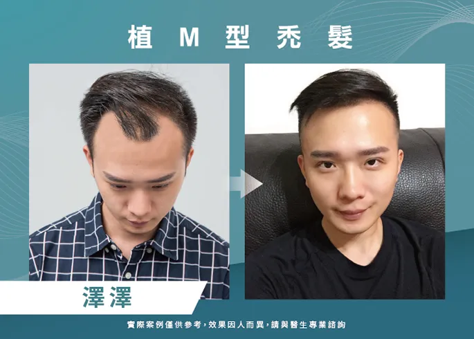 素人澤澤男性髮際線植髮-台南植髮際線