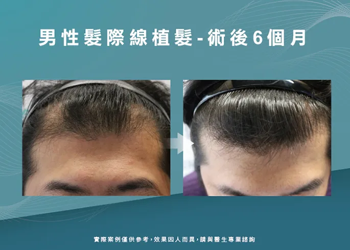男性髮際線植髮術後6個月-台南植髮際線