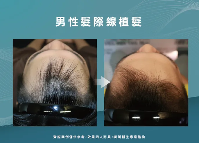 男性髮際線植髮-台南植髮際線