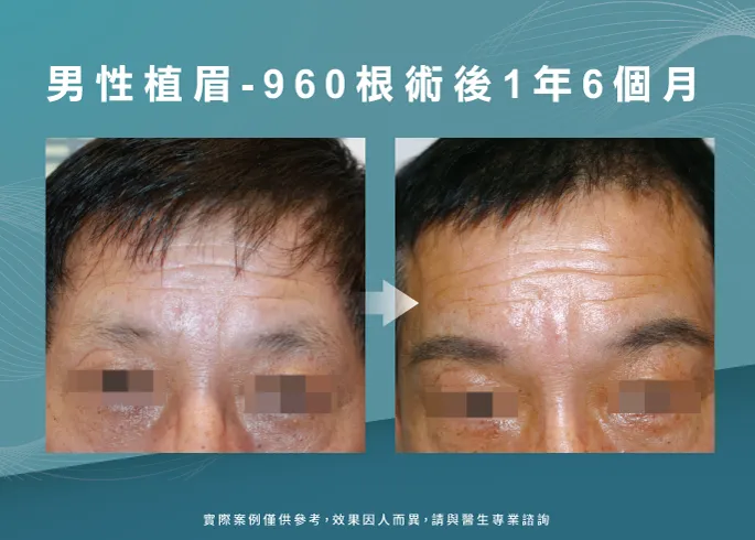 男性植眉1年6個月-台南植眉推薦